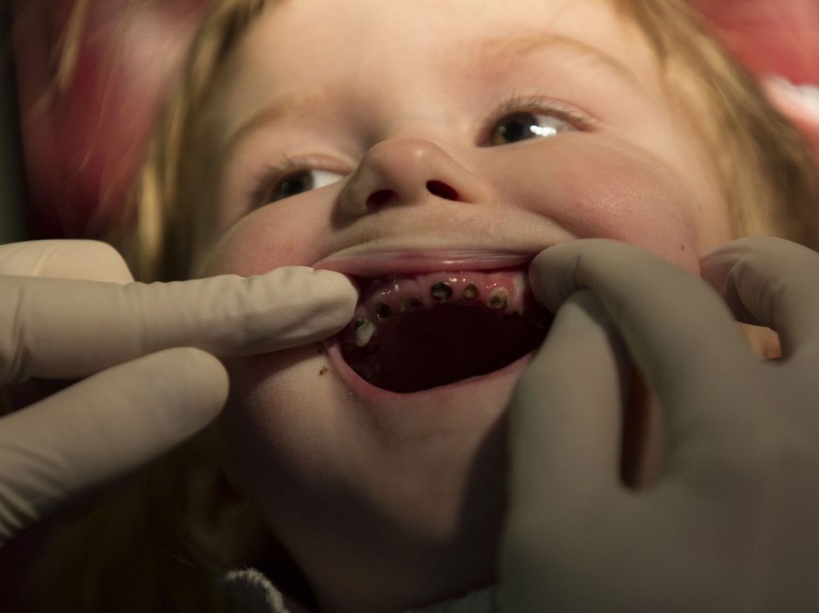 Iana,a four years old girl from Narodichi is being checked by a dentist. After Chernobyl's accident, this region has turned into one of the poorest areas in Ukraine affecting the most vulnerable. Narodichi, UKRAINE - 26/02/2016./VALEROQUINTINA_UKR.014/Credit:Quintina Valero/SIPA/1604112020